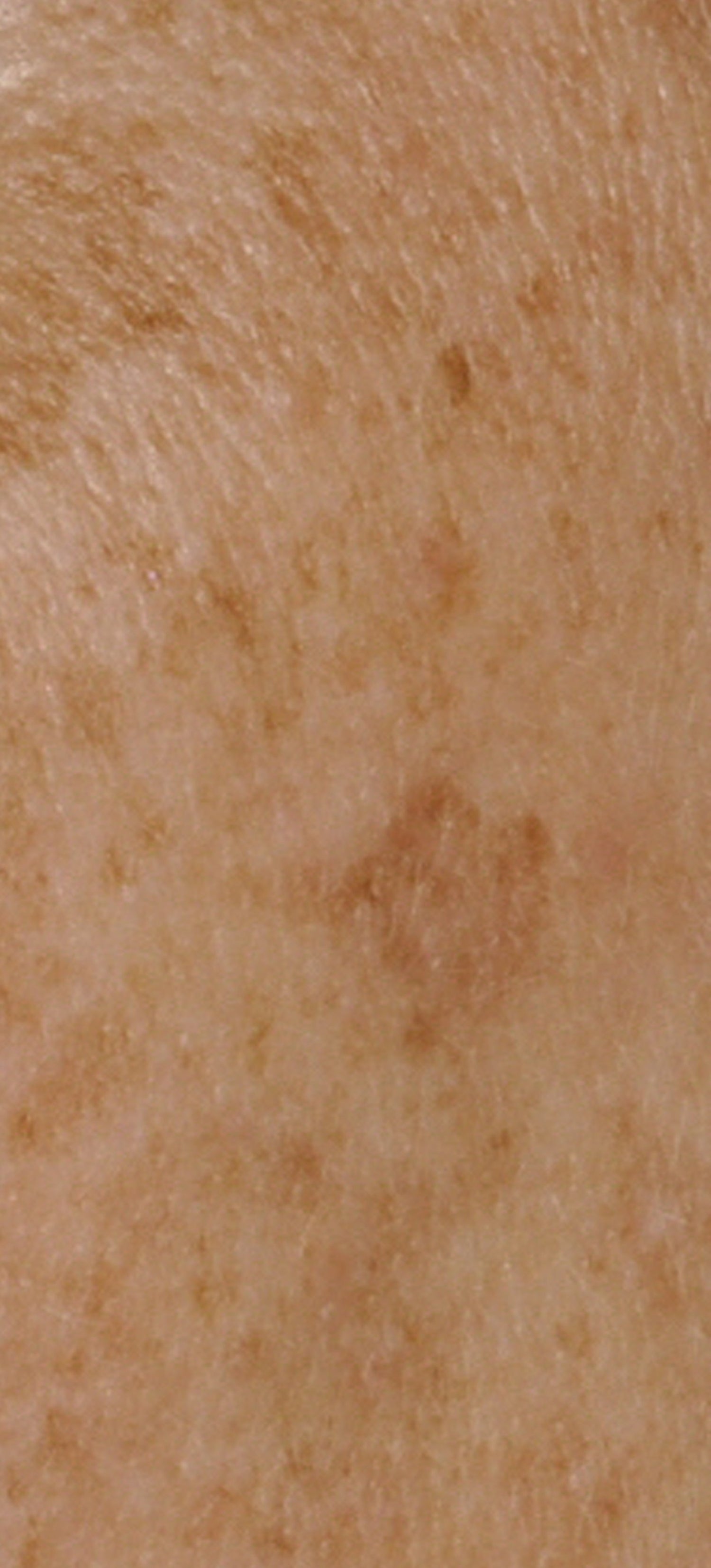 Hyperpigmentierte Haut - KLOTZ LABS Kosmetikmanufaktur