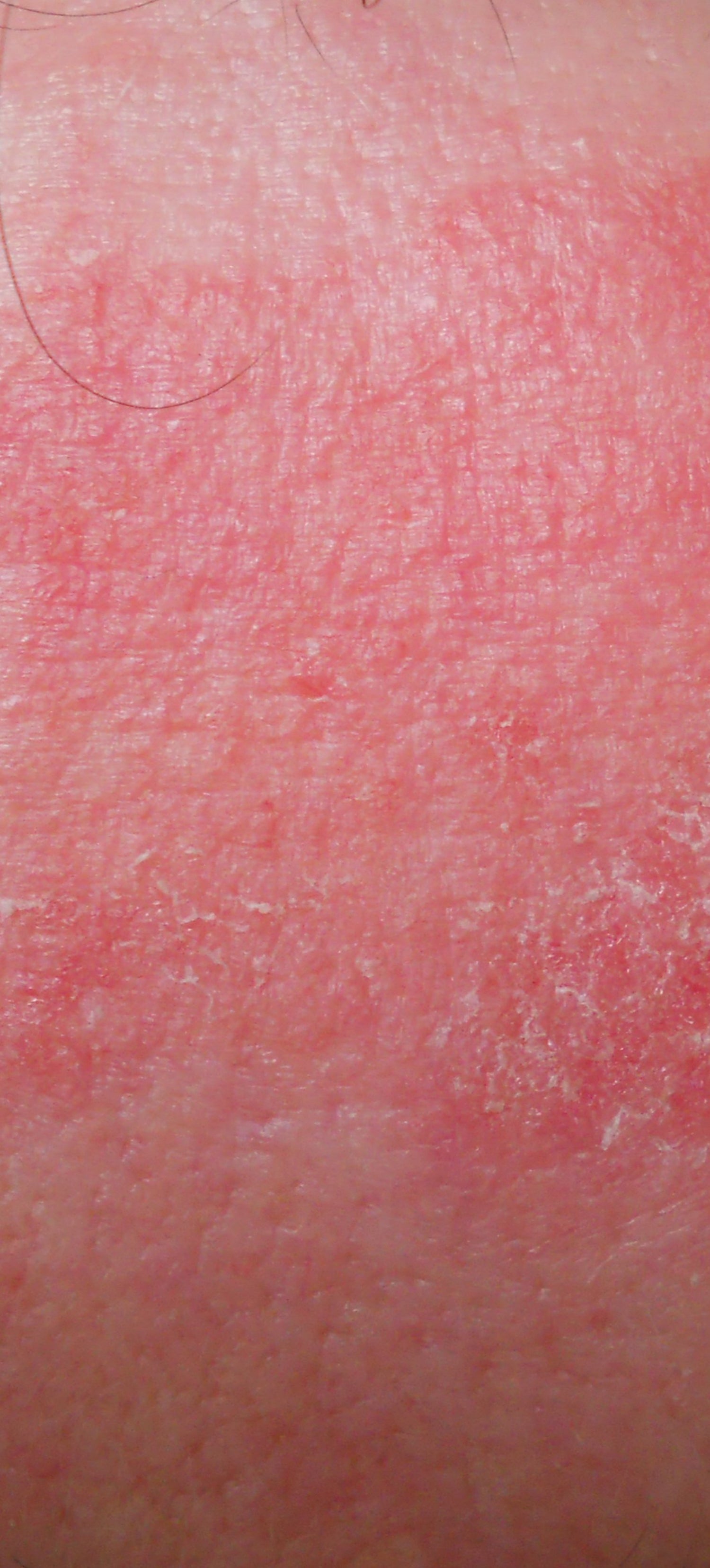 Trockene und entzündete Haut - KLOTZ LABS Kosmetikmanufaktur